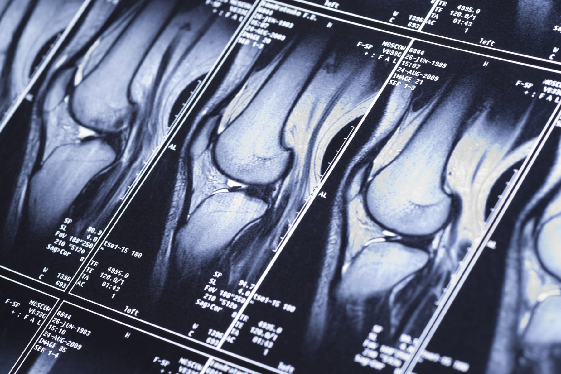 Badanie kolana rezonansem magnetycznym w Warszawie - MRI Diagnostyka Warszawa - prywatna placówka oferująca badanie MRI